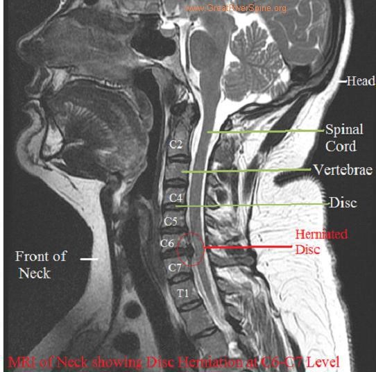 Pinched Nerve In Neck Mri Hot Sex Picture 1441