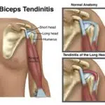 visual of shoulder pain used by beyond wellness, a acupuncturists practice in ashburn va
