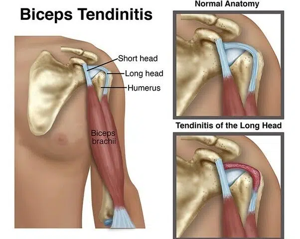 visual of shoulder pain used by beyond wellness, a acupuncturists practice in ashburn va