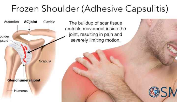 visual of shoulder pain used by beyond wellness, a holistic healing practice in ashburn va