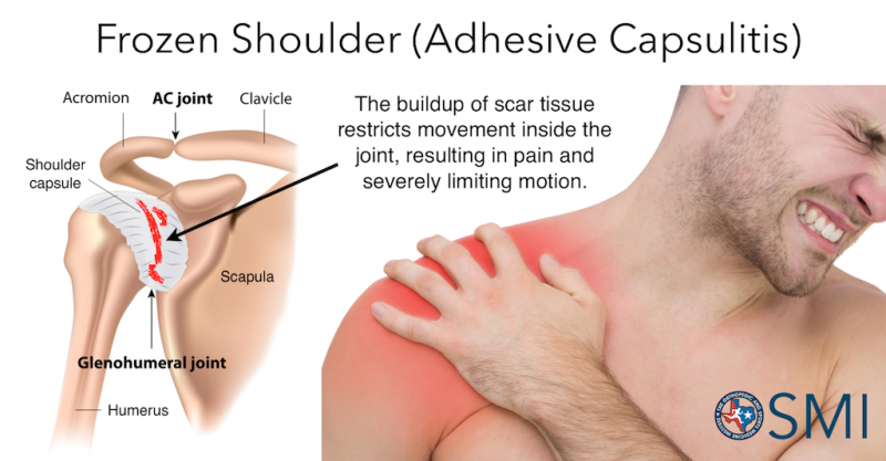 adhesive-capsulitis-therapeutic-massage-beyond-wellness